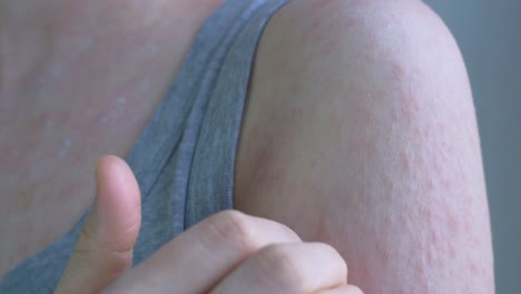 la mujer lleva ropa de casa gris. la piel de la mujer está cubierta de manchas rojas de varios tamaños, que pican. enfermedades virales. primer plano