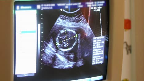 ultrasound image of a fetus