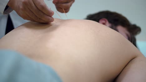 acupuncture treatment session