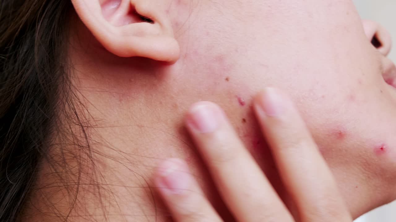 mujeres jóvenes con piel problemática y granos en la cara