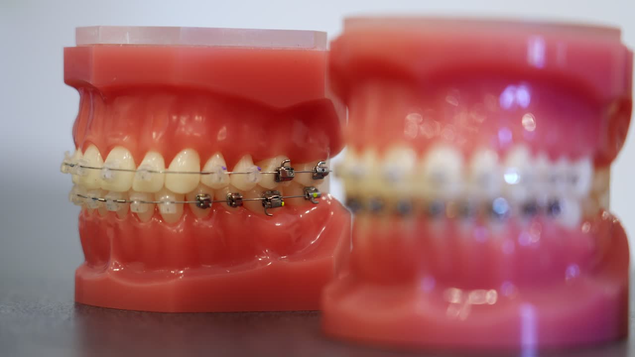 Orthodontic models with braces on teeth