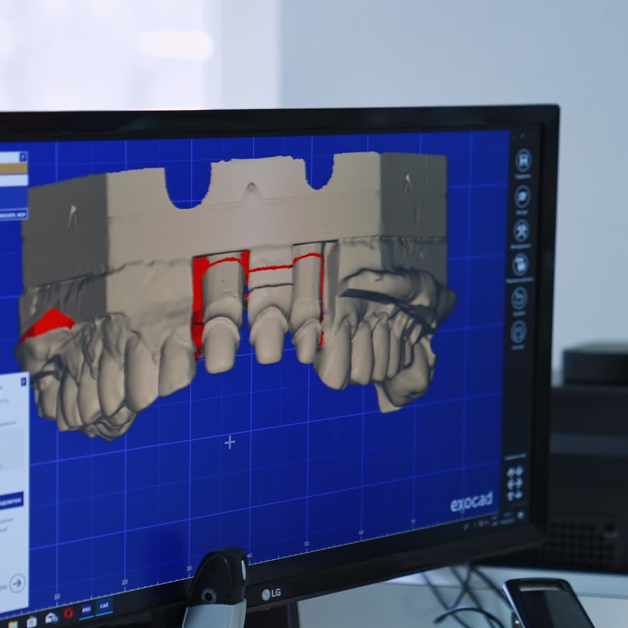 Tela de computador com renderização 3D de uma dentadura. Preparação para implante dos dentes frontais. Close-up