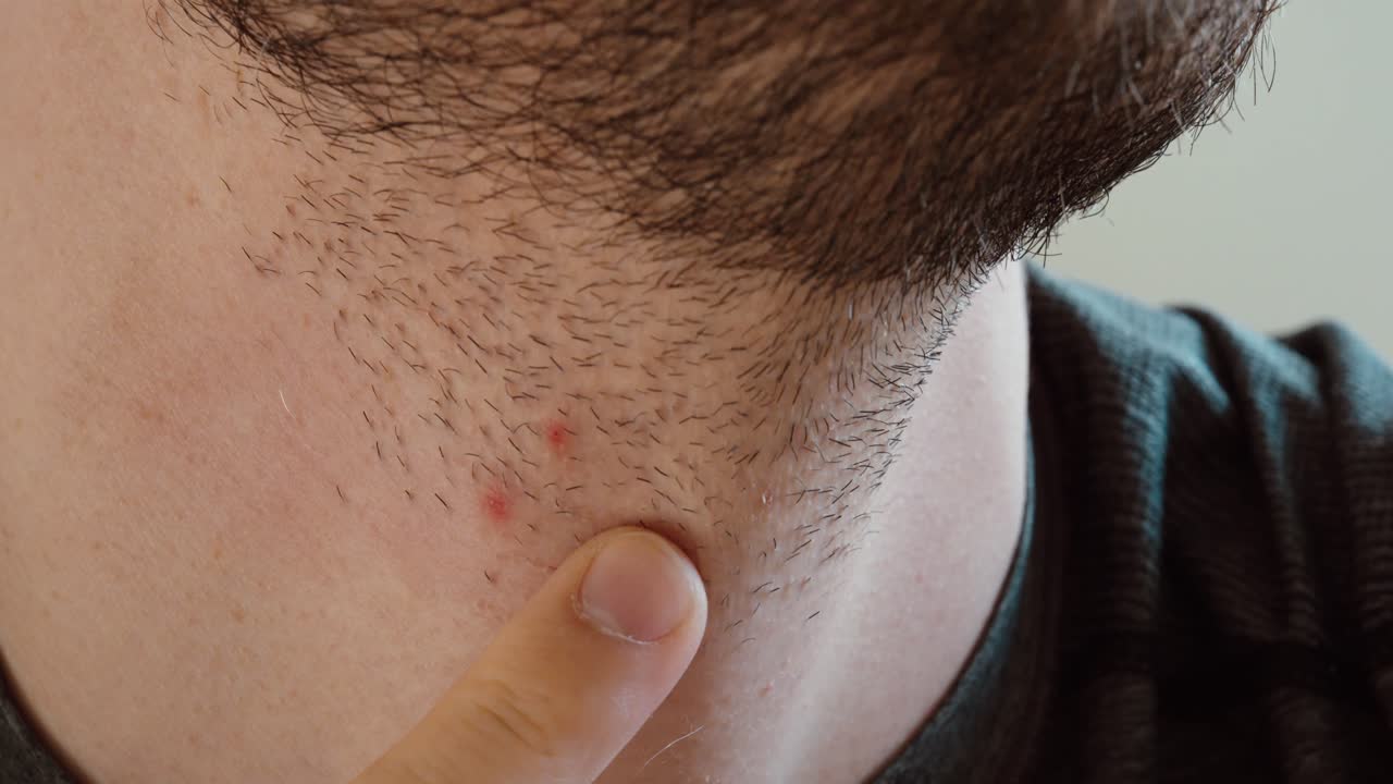 Detail pupínků po holení a podráždění pokožky na krku muže po holení.