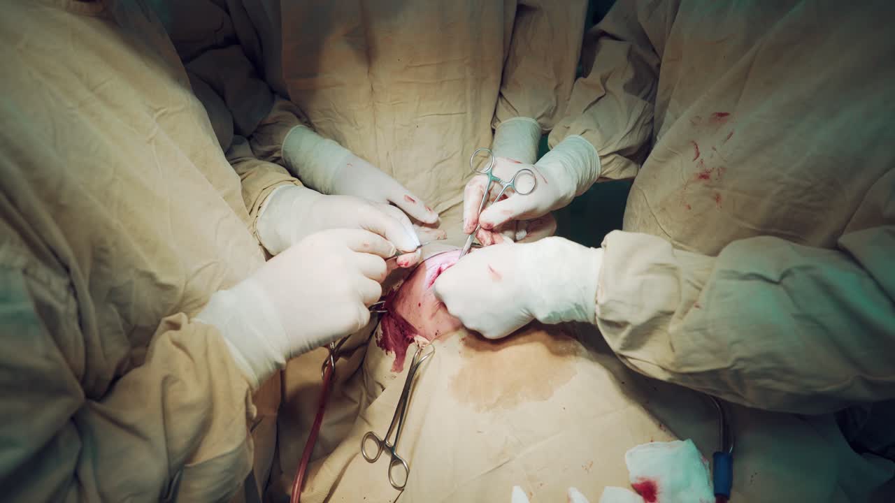Doctors wearing protective clothing performing surgery using sterilised equipment. Group of surgeon at work in operating theatre.