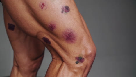 muscle bruises on a leg