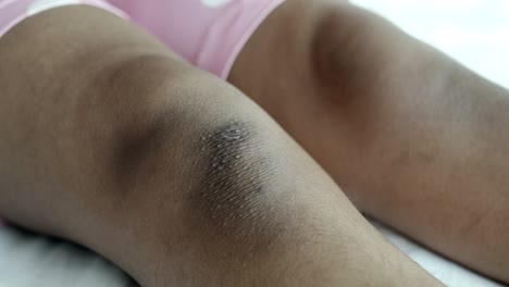 condición de la piel en las rodillas