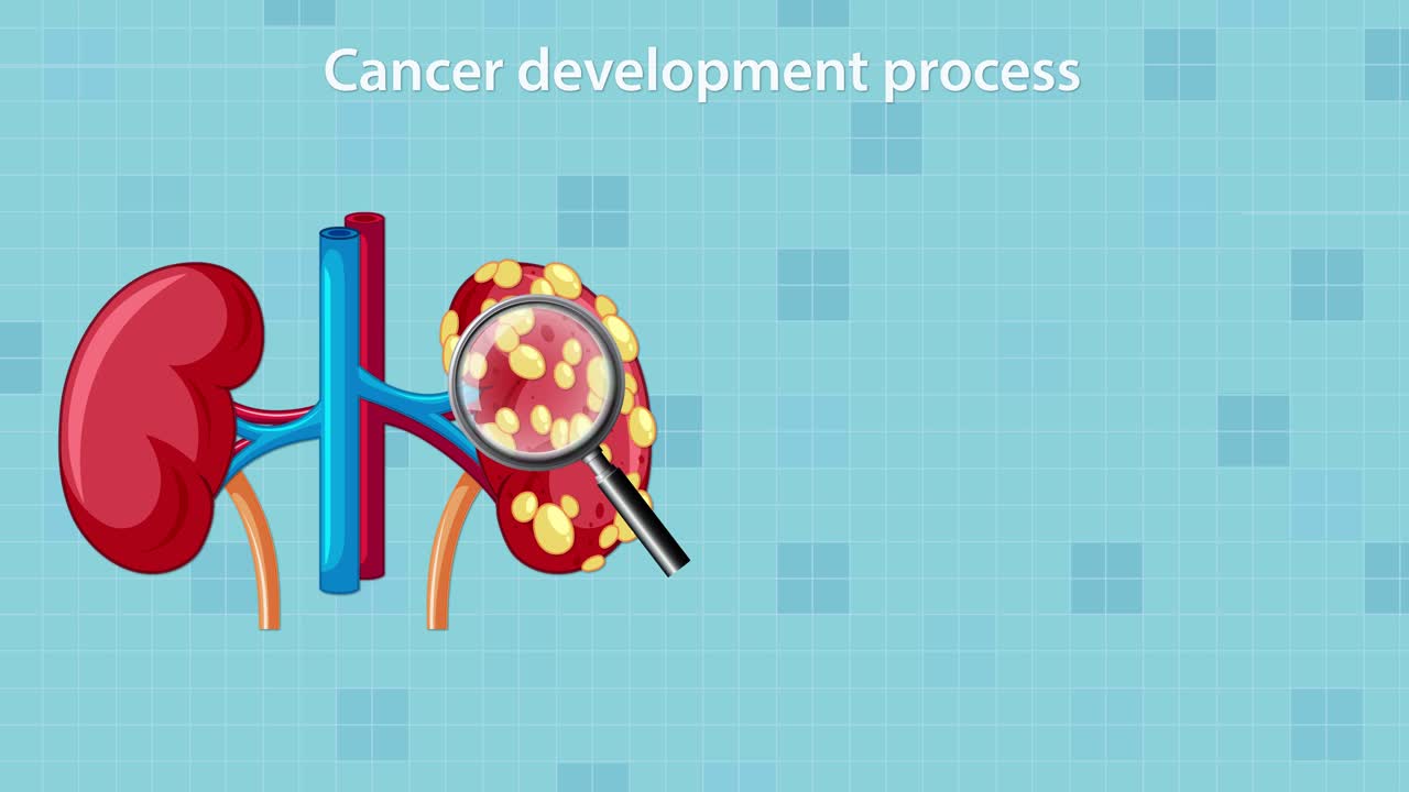 Medical animation illustrates kidney cancer development, highlighting tumor formation, cellular proliferation, and metastatic spread using clear vector graphics and smooth transitions