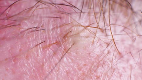 4k super macro shot of hair removal with tweezers, on a caucasian person, at an extreme close up, in a studio