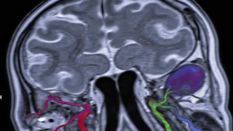 detailed neuroimaging analysis: a comparative study of brain vascular structures showcasing enhanced visualization techniques in mri scans