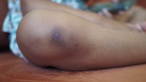 primer plano de la rodilla de un niño con un moretón oscuro o decoloración.