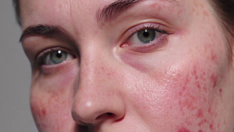 close-up of a person's face with red, irritated skin and acne