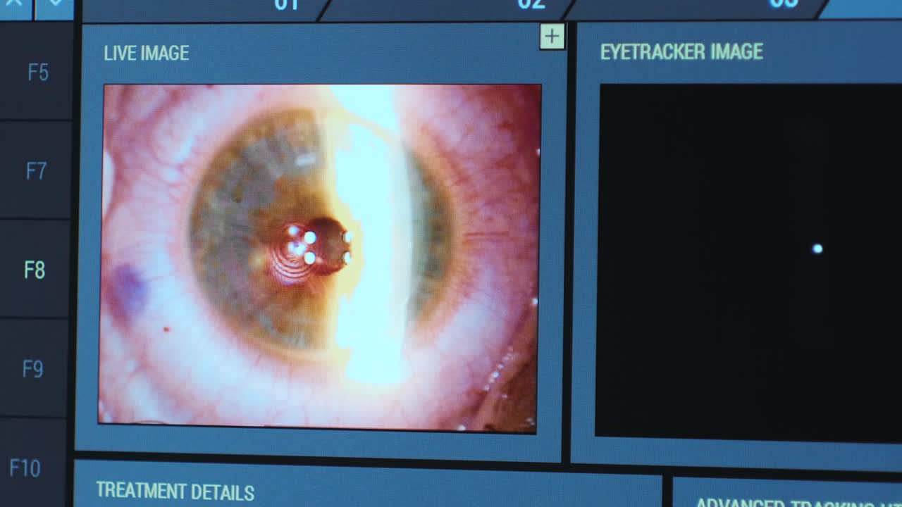 Ophthalmic surgery. View on the screen of medical monitor in operating room. Lasik