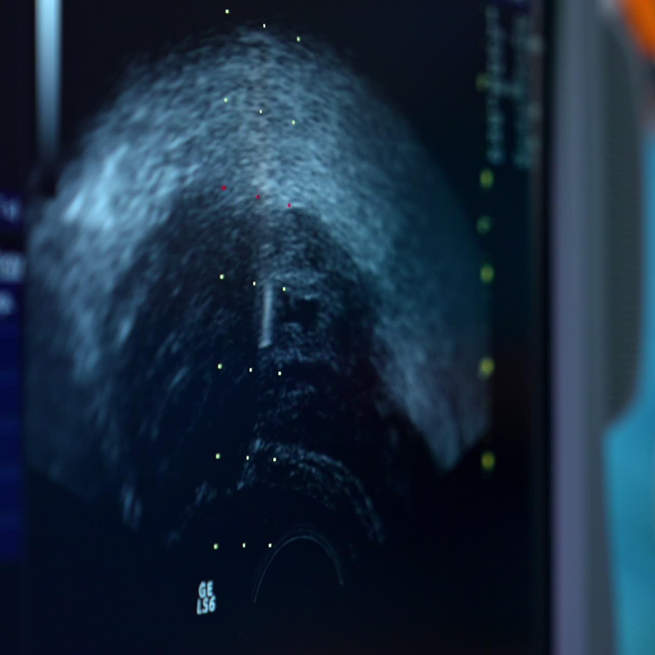 Ultrasonic image on the ultrasound screen. Close up. Checking the abdomen before the IVF procedure. Medic at backdrop in blur