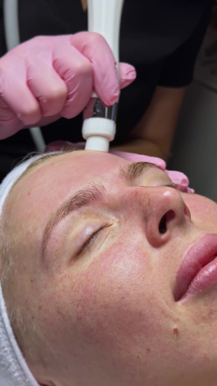 Mujer recibiendo un tratamiento de cuidado de la piel en un salón de belleza al mediodía, mientras una técnica le realiza un procedimiento en la frente
