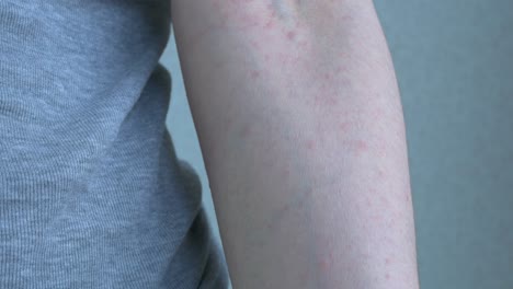 on the right hand, up to the wrist, an allergic reaction is poured out, a rash of pale pink pimples on the skin. viral diseases. close-up