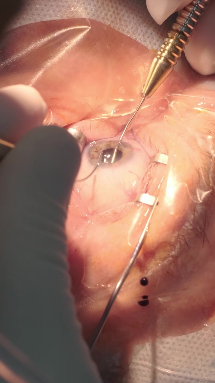 Ophthalmologist Performing Cataract Eye Surgery in Operating Room