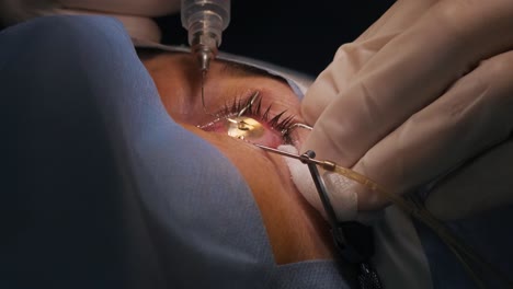 laser vision correction. a patient and team of surgeons in the operating room during ophthalmic surgery. eyelid speculum. lasik treatment. patient under sterile cover