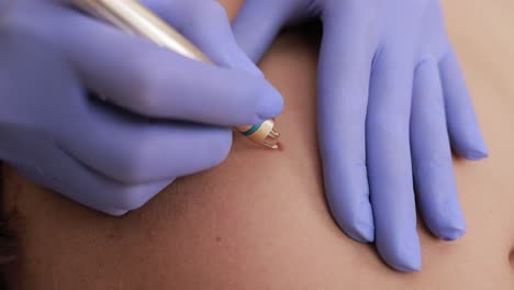 scar removal procedure
