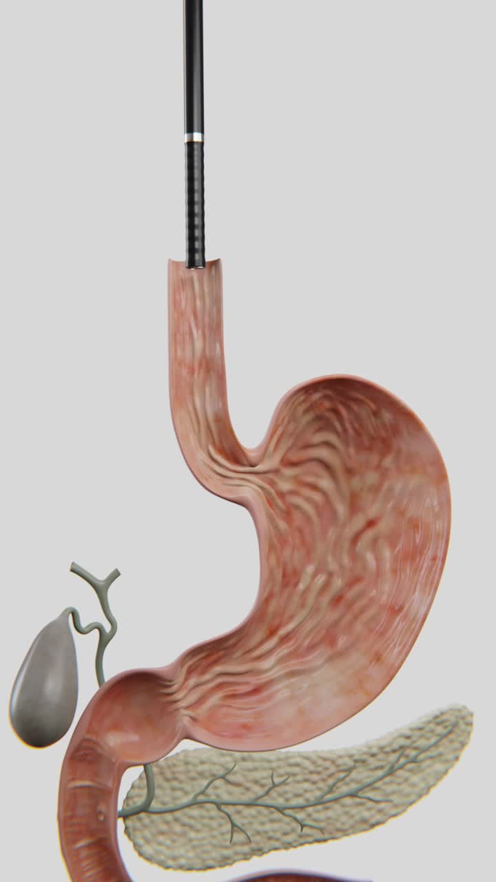 Video of detailed medical illustration depicting a gastroscopy procedure used to visually examine the stomach | Gastroscopy Video in Vertical Format