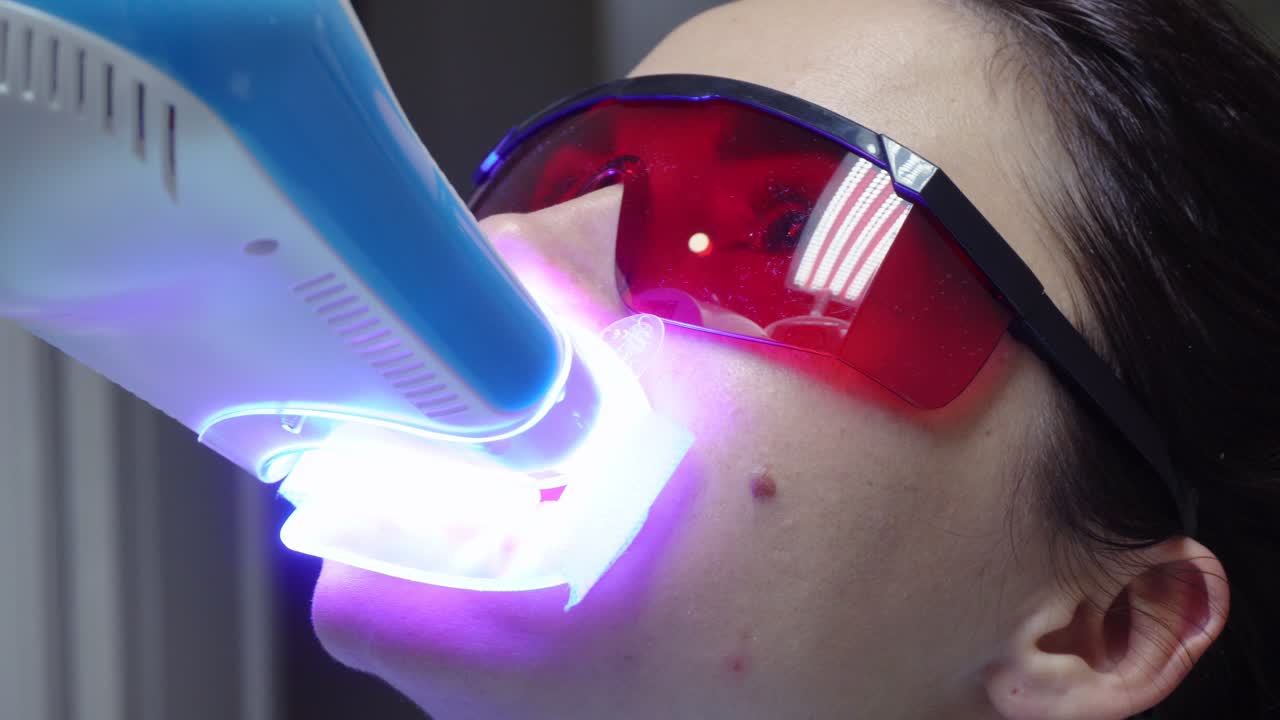 Young woman with an expander in mouth and red protective glasses getting UV whitening at the dentist's office by an ultra violet machine. Shot in 4k