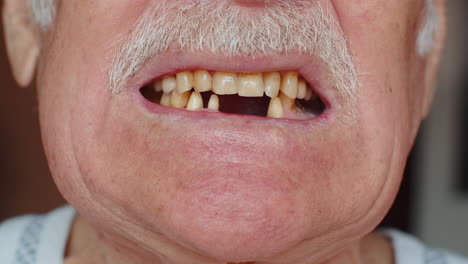 Sonrisa-Masculina-Sin-Dientes-Boca-De-Anciano-Anciano,-Problema-Dental,-Pérdida-De-Dientes-Podridos,-Caries