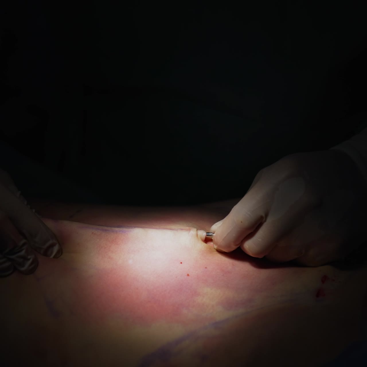 Abdominoplasty. Surgical procedure for removing fat. Doctor's hands in sterile gloves perform a plastic surgery on abdomen on dark background. Liposuction. Close-up