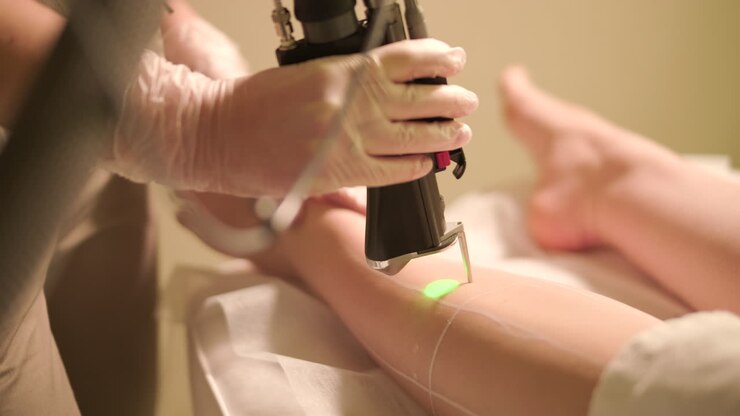 Close-up of Laser Hair Removal Procedure on a Woman's Leg