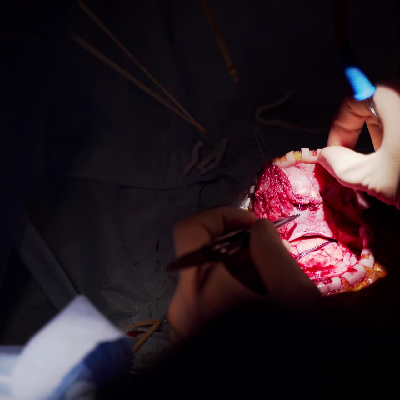 Neurosurgery in light spot in darkness. Hands of a professional doctor perform neurosurgery with medical tools. Close-up.