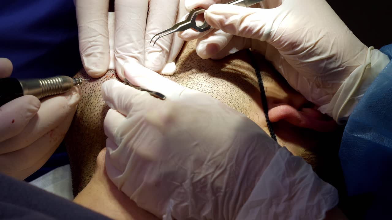 Medici che prelevano peli della barba da un paziente per trapiantarli sul cuoio capelluto, FUE