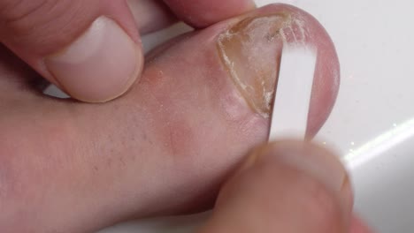 scraping big toe nail infected with mycosis fungal infection