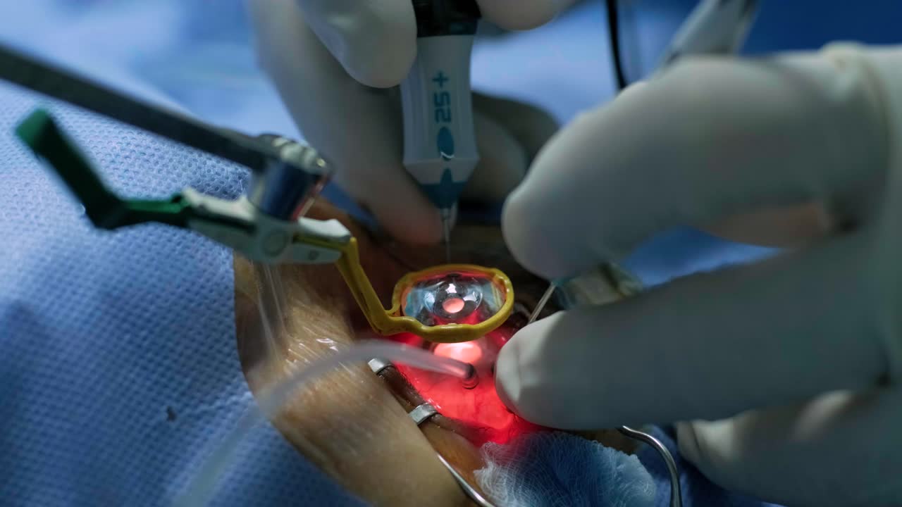 Eye surgery, vitreoretinal. Vitrectomy surgery.