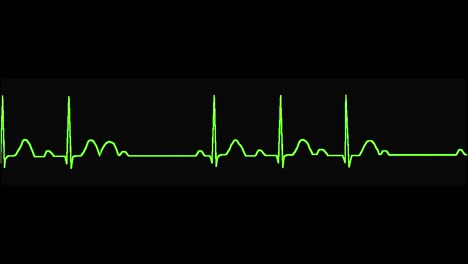el ecg muestra arritmia de segundo grado mobitz 2