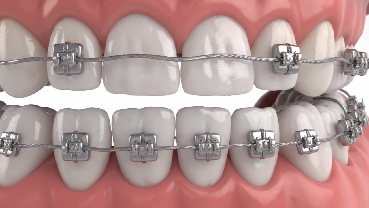 Understanding the Mechanics of Dental Braces: A Visual Guide to Orthodontic Treatment and Alignment of Teeth for Aesthetic and Functional Improvement