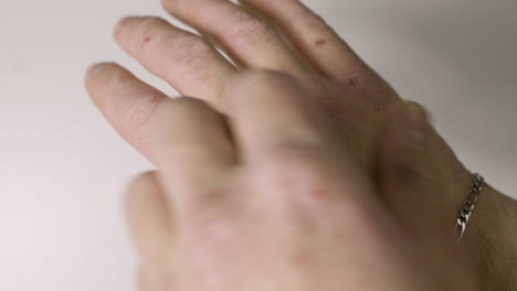 person with hand disease scratching - health problems with skin - close up shot