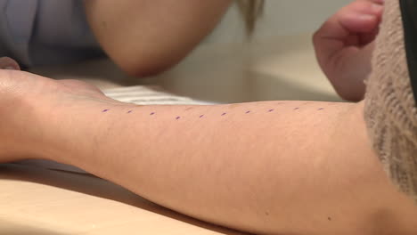 allergy skin test