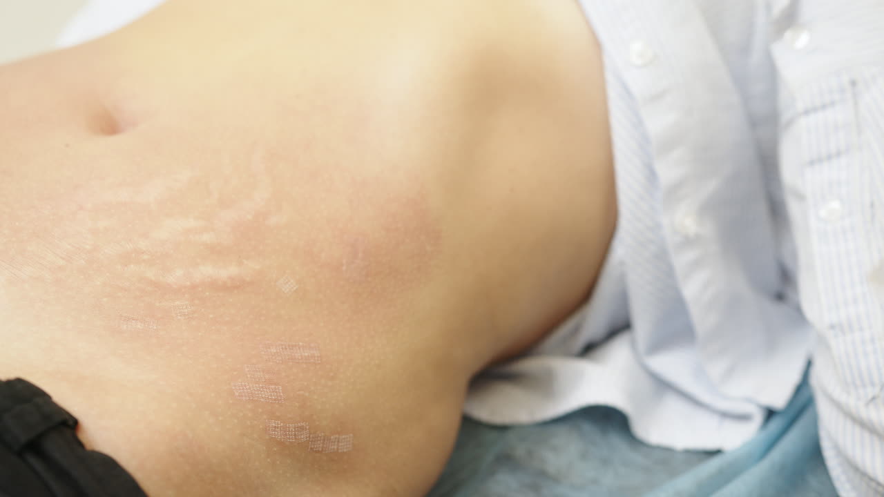 tratamiento con láser para las estrías en el abdomen