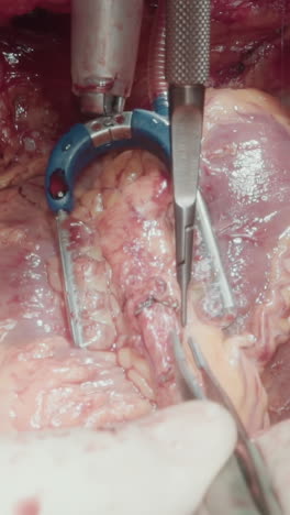 el cirujano utiliza micro pinzas que operan el corazón que late. la mano del médico realiza la cirugía con instrumentos especializados para trabajar en pequeñas arterias coronarias de cerca
