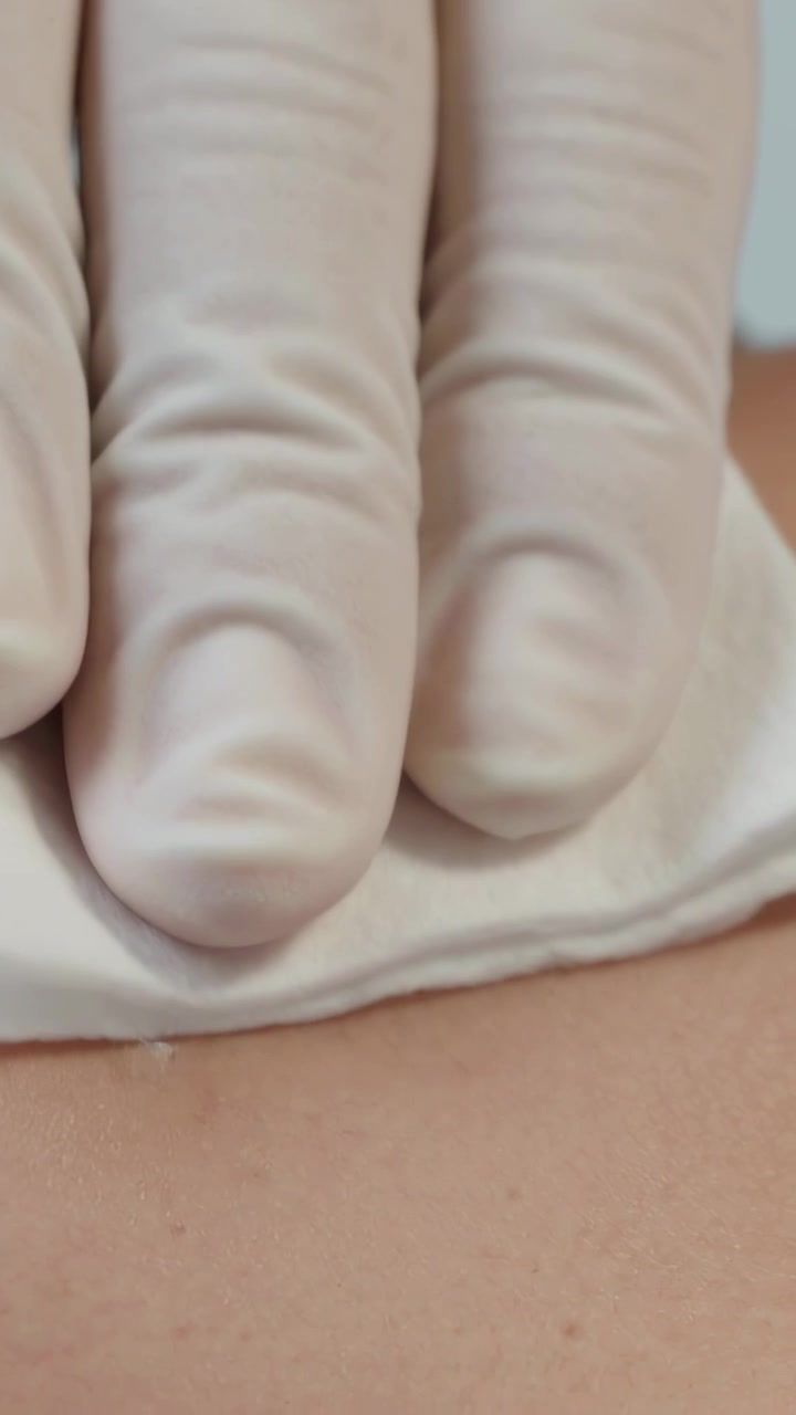 Video verticale: Posizionamento di garza piegata sopra una linea marcata, con un clinico guantato che preme un tampone per il trattamento.