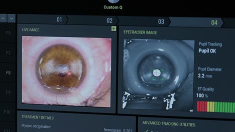 cirugía oftalmológica. vista en la pantalla del monitor médico en la sala de operaciones. lasik