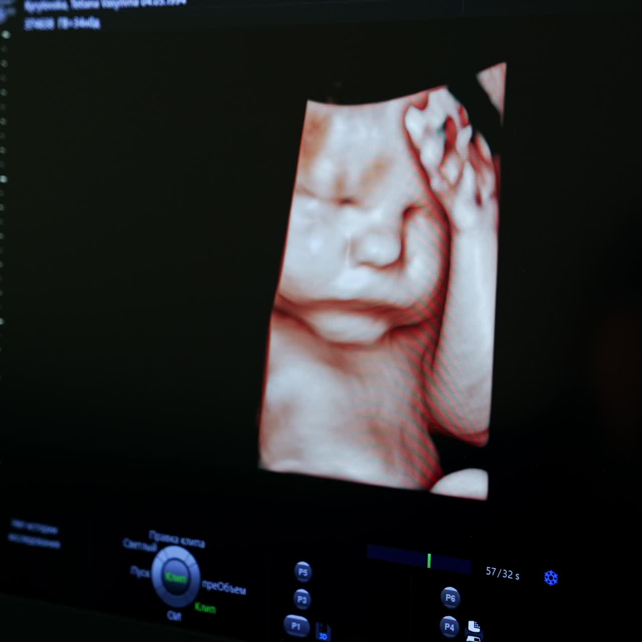 Imagem de um bebê não nascido com a mão na cabeça. Foto 3D fofa de uma criança nos últimos estágios da gravidez em um aparelho de ultrassom. Close-up