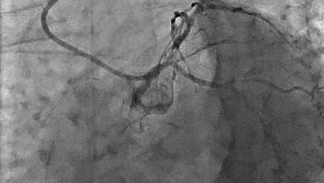 coronary angiogram x-ray of a heart, diagnostic health test in the medical industry