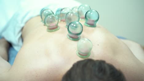 cupping therapy session on back