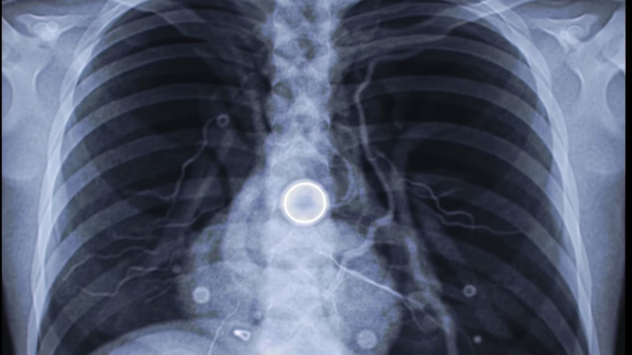 A detailed chest X-ray highlighting the lung structure and heart position. It provides a clear view of the thoracic anatomy for medical examination purposes.