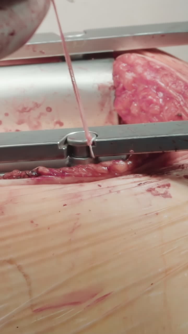 il medico utilizza fili per chiudere il retrattore. gli spargitori di costole metalliche aprono la cavità fornendo accesso agli organi per un'efficace chirurgia di bypass dell'arteria coronaria