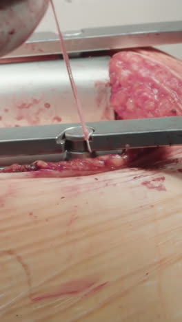 el médico utiliza hilos para cerrar el retractor. los difusores de costillas metálicas abren la cavidad proporcionando acceso a los órganos para una cirugía de derivación de la arteria coronaria efectiva
