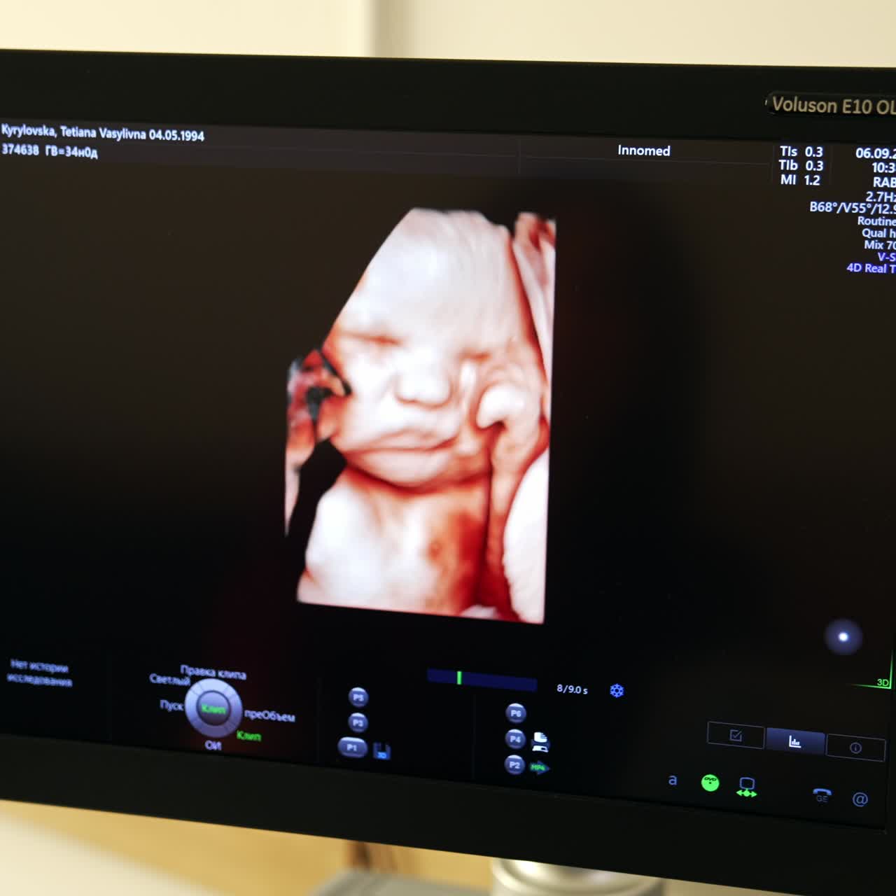 Ultrason cihazının ekranında, minik yumruklarını yüzüne doğru tutan sevimli bir prenatal bebek resmi.