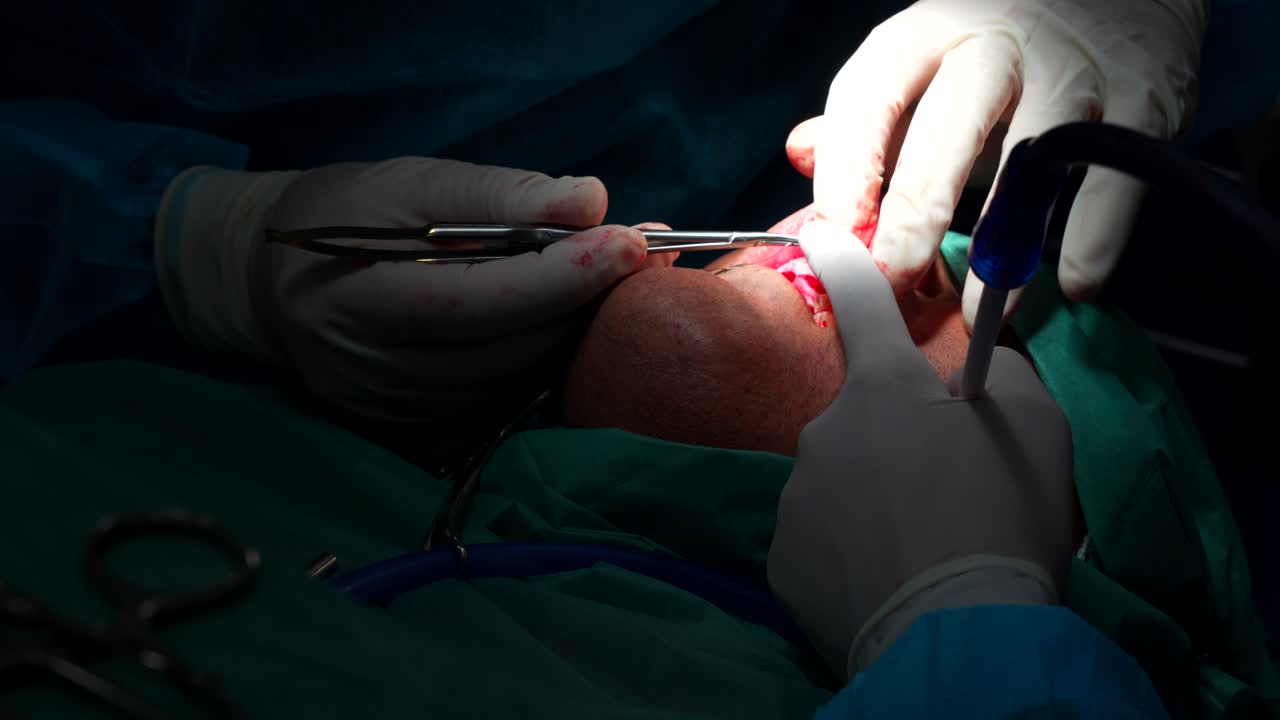 крупный план стоматолога, зашивающего десны пациента после операции по удалению зуба, 4к