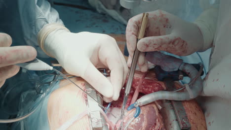 surgeon attaches graft to artery. experienced doctor with assistant uses medical equipment performing coronary artery bypass surgery in operating room