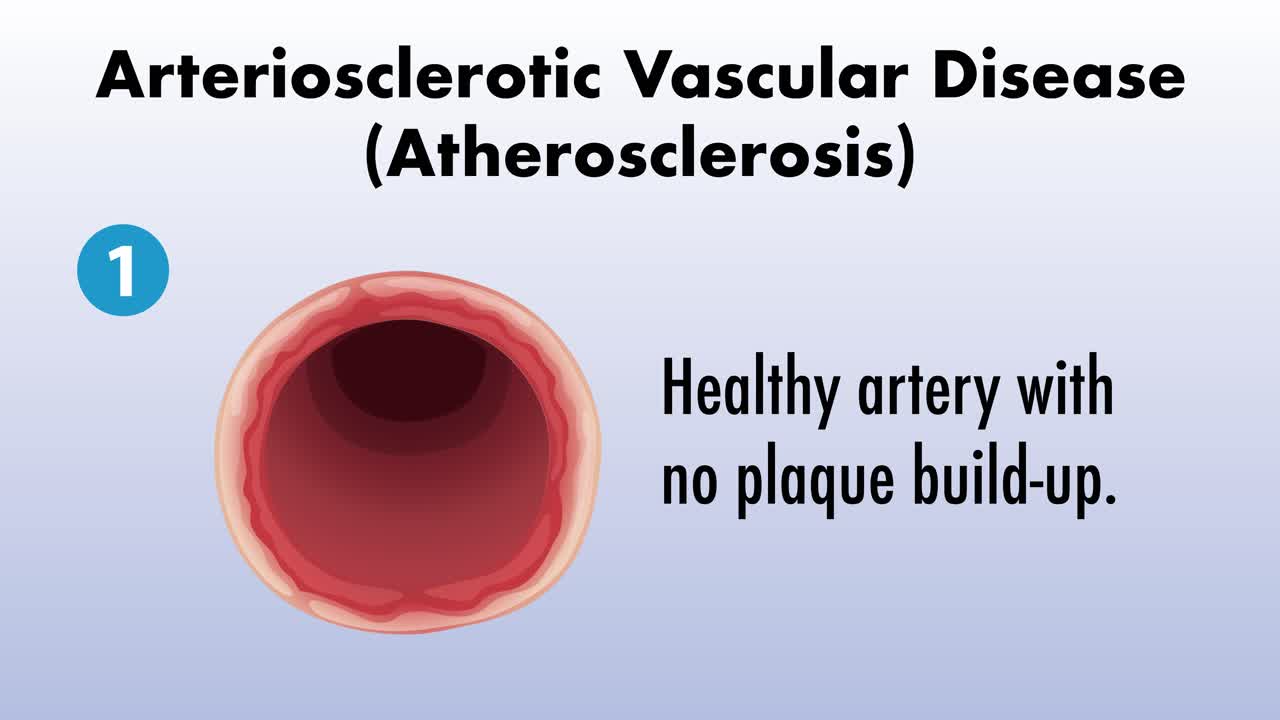동맥 플래크 축적의 단계를 시각화합니다.