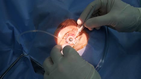 eye surgery, vitreoretinal. vitrectomy surgery.